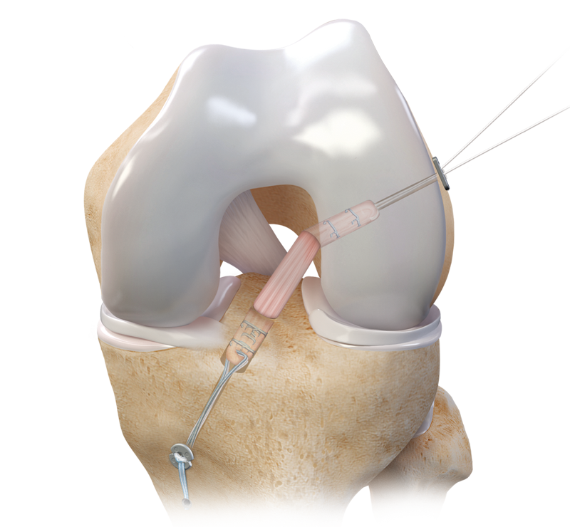 Arthrex - QuadLink Construct Tendon - FQL Arthrex - QuadLink Construct Tendon - FQL